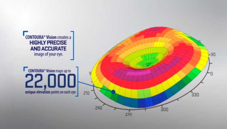컨투라라섹 원리와 장점: 야간 빛번짐 및 난시 교정에 효과적인 이유