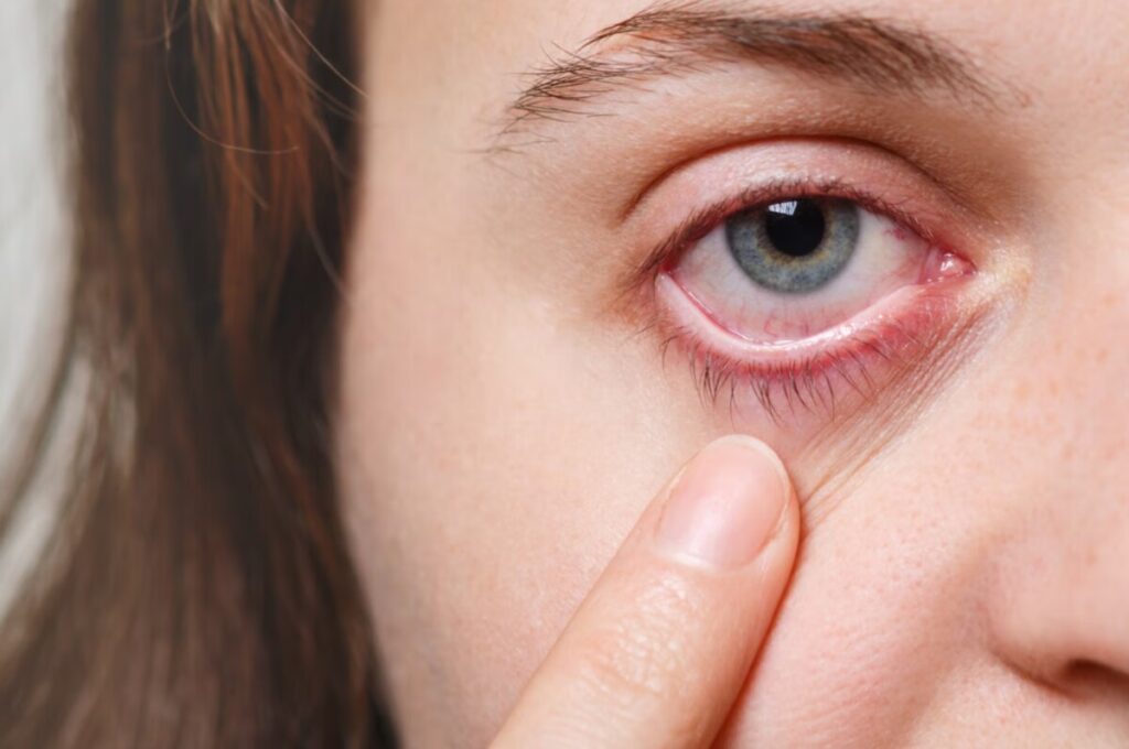 눈 흰자가 투명하게 물집처럼 부풀어 오른 결막부종의 실제 증상 사례 이미지