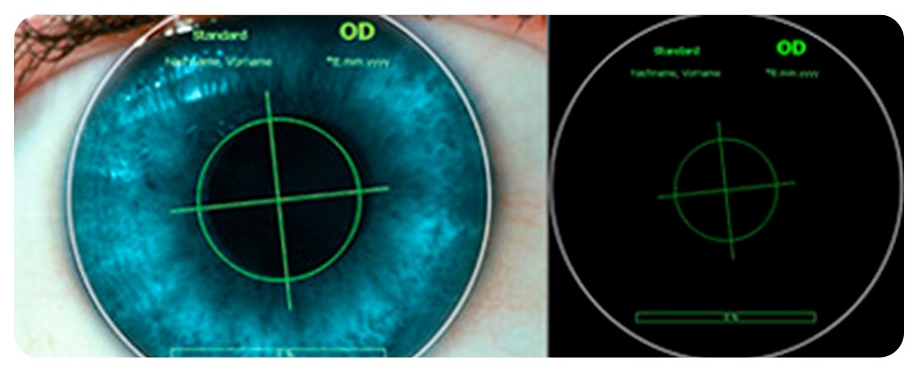 컨투라라섹의 정밀한 난시 교정을 위해 각막 지형도 데이터를 바탕으로 난시축과 각막 굴곡을 계산하는 시뮬레이션 이미지