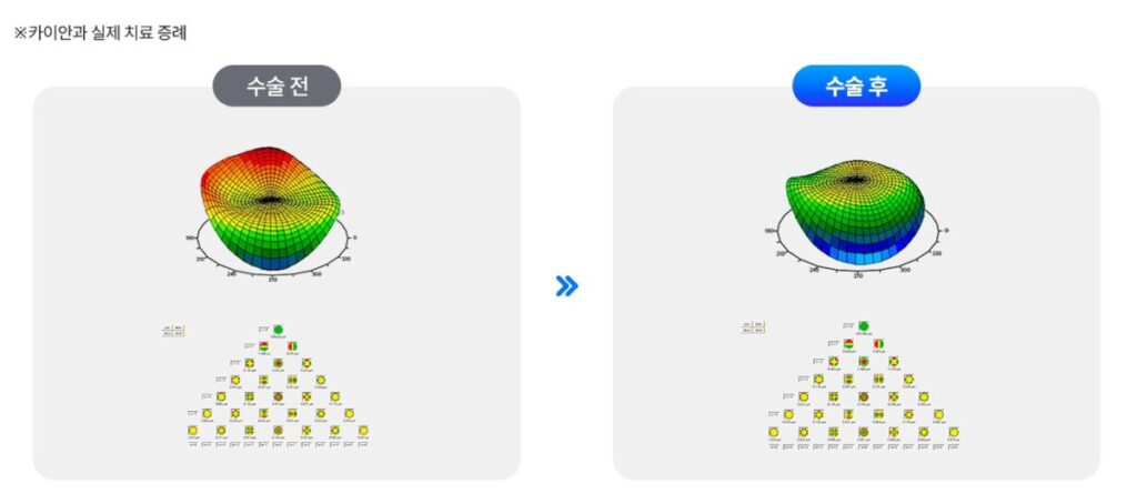 각막 지형도 검사를 통해 각막 표면의 높낮이를 입체적으로 분석한 컨투라 비전 데이터