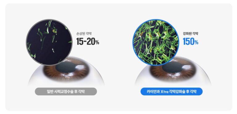 각막강화술(엑스트라), 시력교정술 후 각막확장증 예방을 위한 필수 가이드