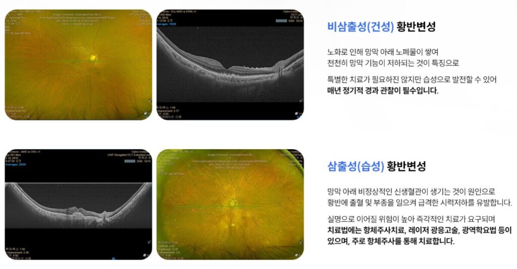 건성 황반변성의 드루젠 노폐물과 습성 황반변성의 망막 부종 및 출혈 차이를 보여주는 OCT 검사 데이터
