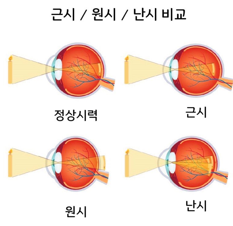 먼 곳이 흐릿한 근시 vs 겹쳐 보이는 난시 차이, 한눈에 비교하기