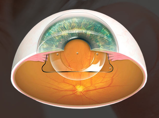 ICL렌즈삽입술부작용 예방하려면? 수술 전 체크리스트 5가지