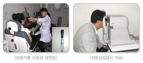 ICL 렌즈 부작용, 렌즈삽입술 후기, 각막 내피 세포, 렌즈삽입술 부작용, 렌즈삽입술 가격