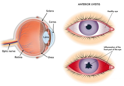 포도막염 증상 및 원인 3가지, 치료 시기 놓치면 실명 위험?