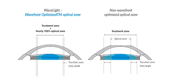 각막 상피를 제거하고 레이저를 조사하는 라섹(LASEK) 시력교정술의 단계별 과정도
