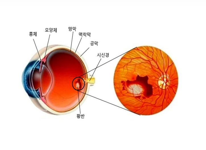 사물이 찌그러져 보인다면? 황반변성 증상과 예방을 위한 필수 가이드