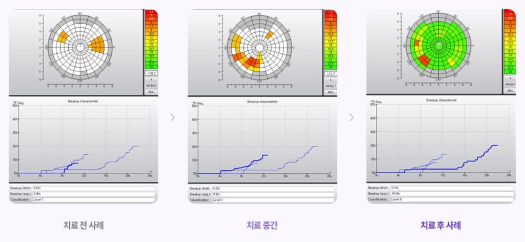 마이봄샘 기능 장애 치료 전과 후, 기름샘의 입구가 깨끗해지고 눈물막 안정성이 개선된 검사 결과 시각화 데이터