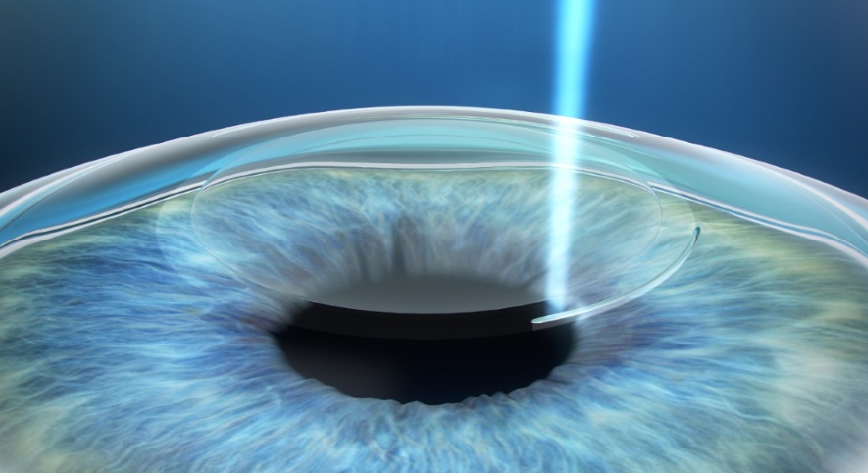 각막 절편 생성 없이 미세 절개로 진행되는 스마일라식의 정교한 시력 교정 수술 과정