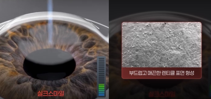 실크라식 수술 후 매끄럽게 절삭된 각막 표면과 일반 수술의 단면 비교 이미지