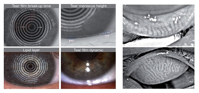 눈물이 자꾸 흐를 때, 눈이 건조하다는 신호일까?