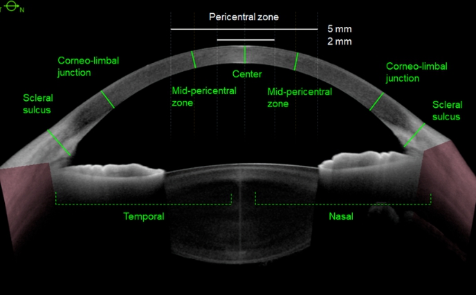 스마일라식각막두께 조건을 확인하고 있다면?