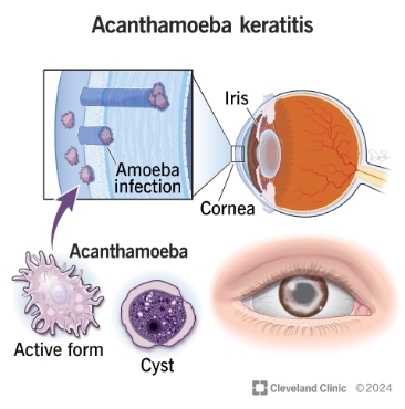 가시아메바 각막염 증상, 렌즈 낀 채 샤워했다면? 실명 위험?