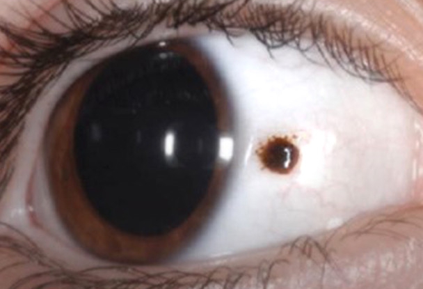 눈안에검은점,단순한 점일까 질환일까?