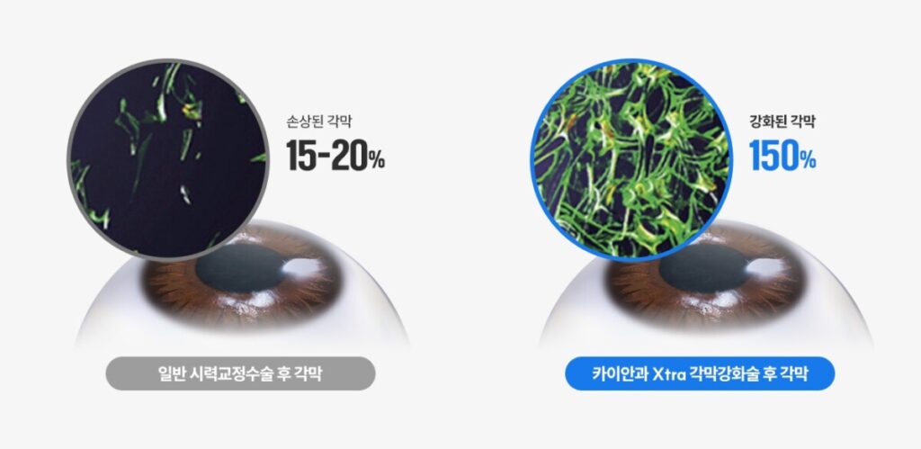 스마일라식 각막두께가 약한 분들을 위한 옵션을 설명하는 이미지