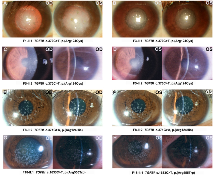 각막이영양증 주요 증상과 진단방법을 알아본다면?
